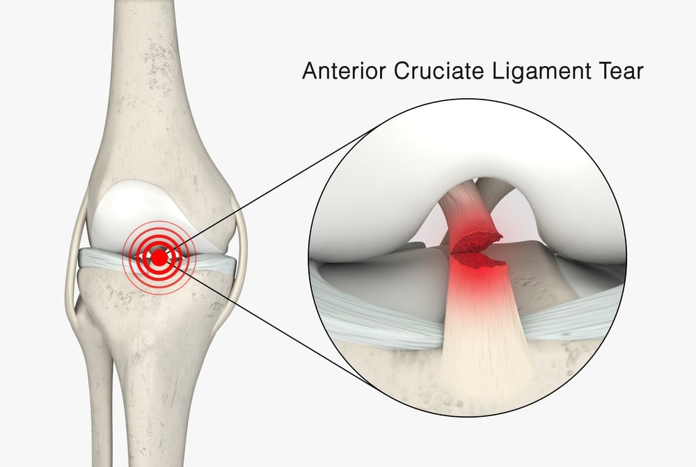 ACL Tear Orthopedics