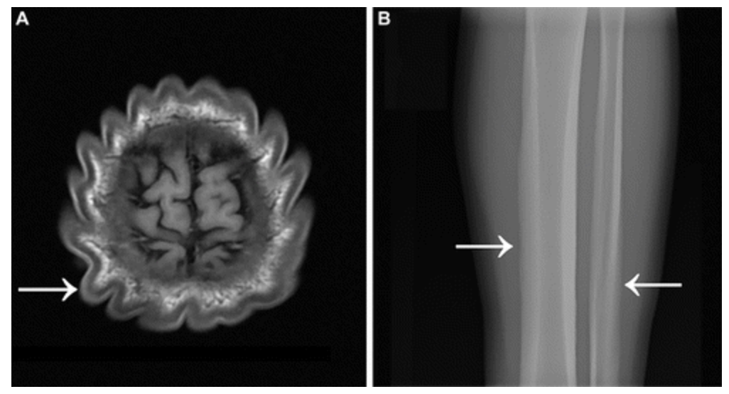 RSNA Petals Image